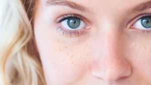 Milialar skin disease